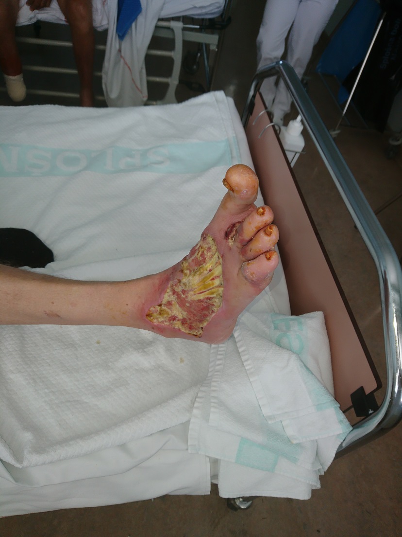 Slabo celjenje rane ogroža ud. Preti podkolenska amputacija noge.